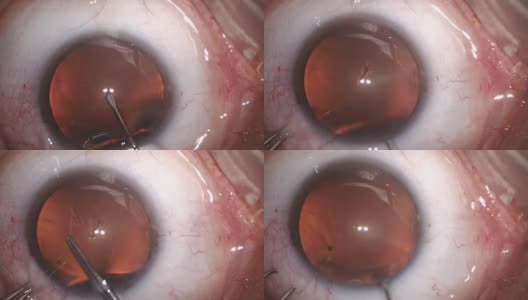 白内障眼科手术高清在线视频素材下载