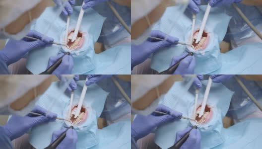 牙科医生的手戴着蓝手套，在牙科诊所里治疗戴着保护装置的妇女的牙齿。保健和医学的概念。高清在线视频素材下载