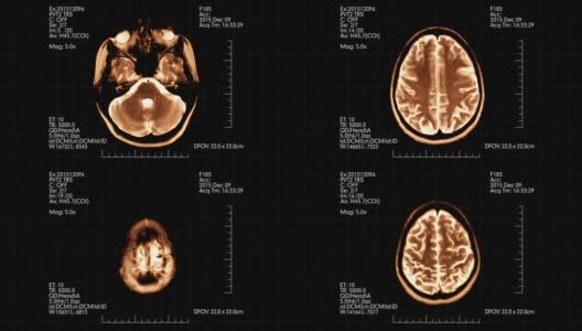 橙色俯视图脑mri扫描医学显示动画高清在线视频素材下载