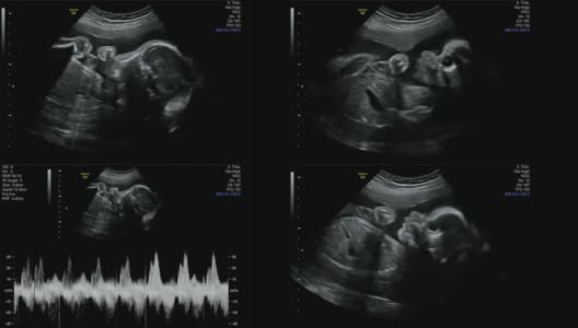 不可思议的婴儿心率声-超声扫描妊娠3d和4d超声检查妊娠胎儿人类胚胎检查胎儿超声检查26周中期妊娠女婴高清在线视频素材下载