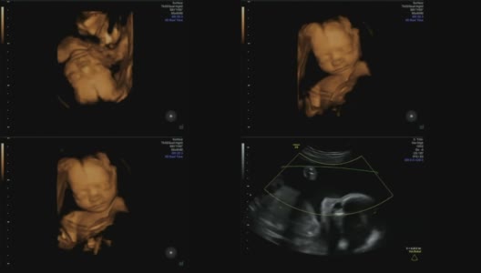 婴儿在母亲的子宫里享受平静的生活-超声扫描妊娠3d和4d超声检查妊娠胎儿人类胚胎检查胎儿超声检查26周妊娠中期高清在线视频素材下载