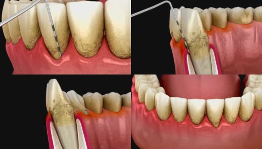 牙周炎测试，牙龈衰退过程。医学精准3D动画高清在线视频素材下载