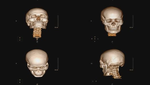 外伤患者颅骨/面骨的CT扫描高清在线视频素材下载
