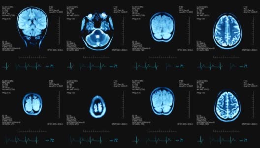 两个俯视图mri大脑扫描图像动画医学显示与心脏跳动和其他医疗数据高清在线视频素材下载