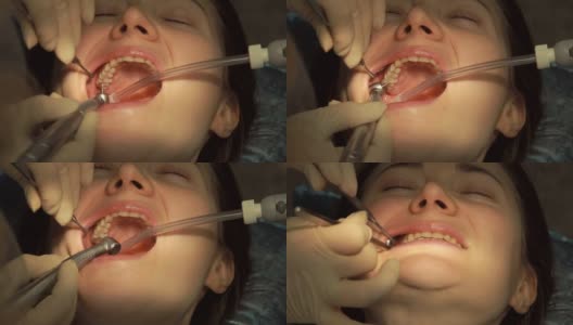 牙科医生和助手补牙高清在线视频素材下载