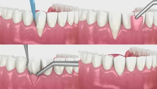 牙龈萎缩:软组织移植手术。牙科程序的3D动画高清在线视频素材下载