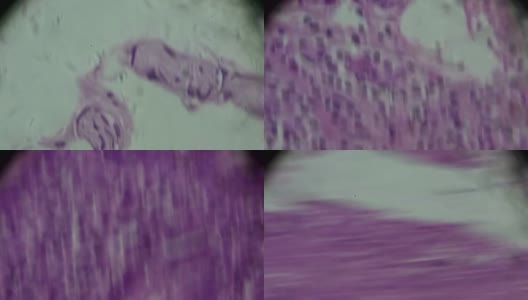 镜下化脓性炎症(阑尾、脑)病理标本高清在线视频素材下载