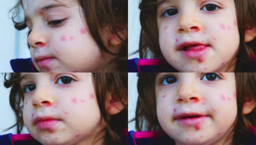 水痘疹近红点皮肤状况对儿童面部细节脓高清在线视频素材下载
