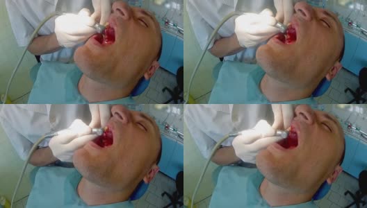 由于牙医的干预，病人的牙龈出血，关闭高清在线视频素材下载