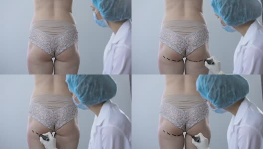 女医生在屁股上画记号，准备做抽脂手术高清在线视频素材下载