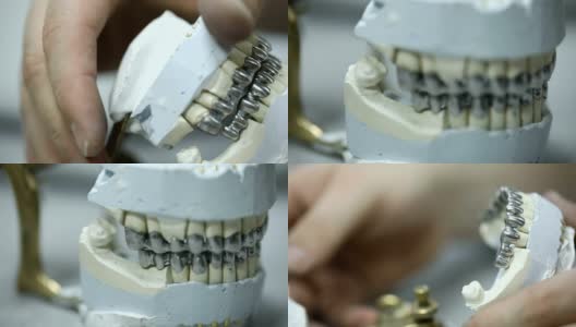 石膏颌上的牙桥高清在线视频素材下载