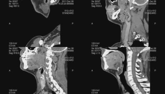 人颈部矢状面CT扫描高清在线视频素材下载
