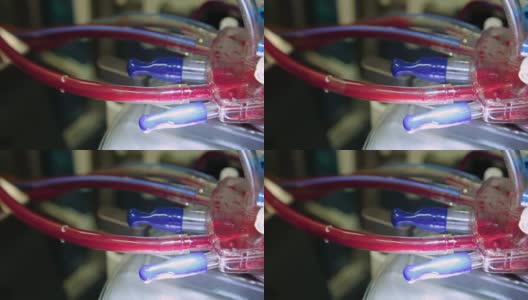 近距离操作心肺机用管子和皮瓣来输送血液高清在线视频素材下载