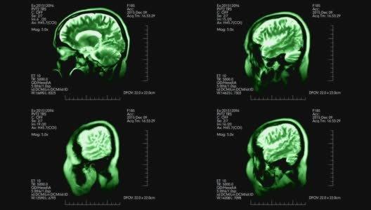 绿色侧视图MRI脑部扫描显示动态医疗数据高清在线视频素材下载