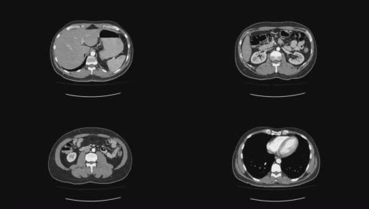 上腹部Ct扫描，俯视图平滑运动高清在线视频素材下载