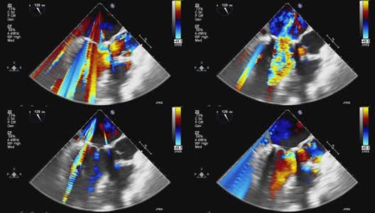 高品质影像超声经食管心脏检查。高清在线视频素材下载