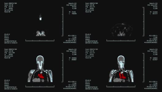 医学MRI扫描仪显示，CT或CAT图像高清在线视频素材下载