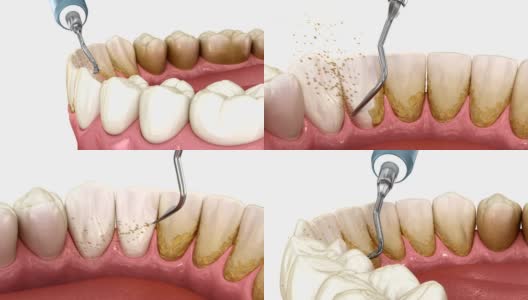 口腔卫生:超声波洁牙(常规牙周治疗)。医学上精确的人类牙齿治疗3D动画高清在线视频素材下载