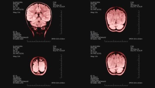 MRI脑部扫描粉红色医学显示动画高清在线视频素材下载