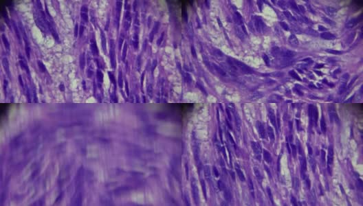 子宫平滑肌瘤活检标本在光镜下不同区域放大高清在线视频素材下载