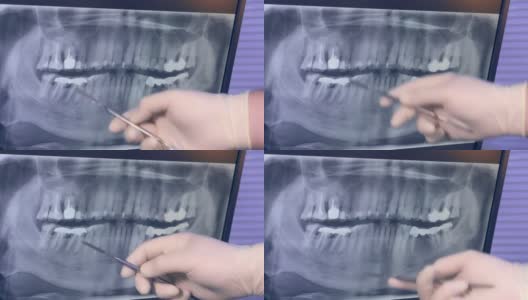 全景x光的牙齿在监视器和医生的手在手套与工具高清在线视频素材下载