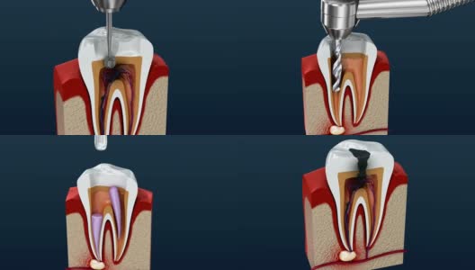 根管治疗过程。3 d动画。高清在线视频素材下载