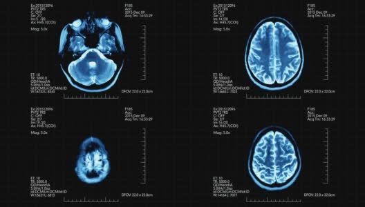 俯视图蓝绿色MRI脑部扫描显示动画数字和文字高清在线视频素材下载