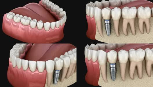 前磨牙种植修复。医学上精确的人类牙齿和假牙的三维动画概念高清在线视频素材下载