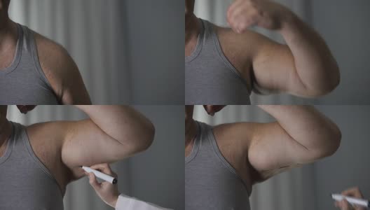 女性整形外科医生在肥胖男性手臂松弛皮肤上划线，保健高清在线视频素材下载