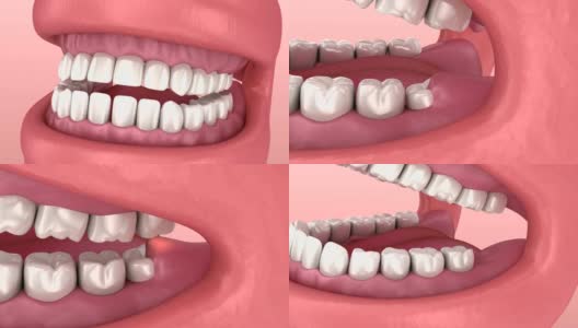 智齿的问题。医学上准确的牙齿3D动画高清在线视频素材下载