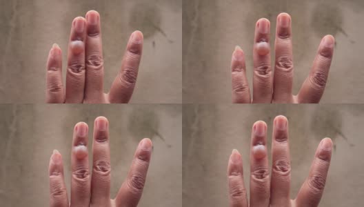 左手手指有无名指被开水烫伤的伤口高清在线视频素材下载