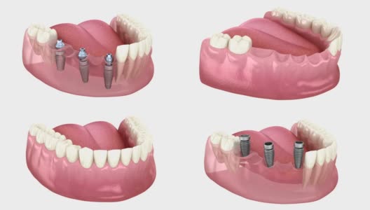 基于3个种植体的牙桥。医学上精确的人类牙齿和假牙的三维动画概念高清在线视频素材下载