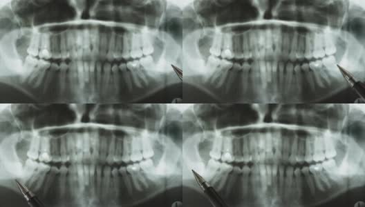 牙科全景x光的特写。笔尖指向下颌智齿位置异常高清在线视频素材下载