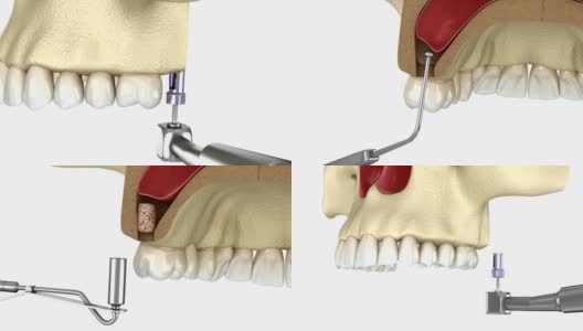 额窦提升手术。牙科手术的3D动画高清在线视频素材下载