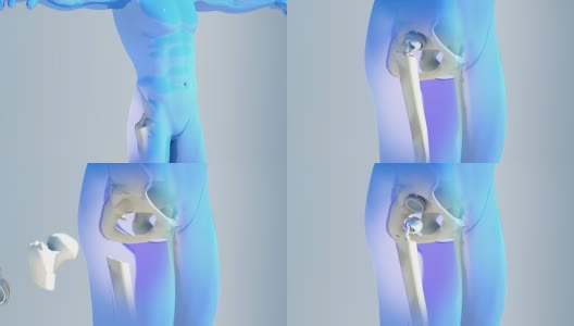 髋关节置换植入物安装在骨盆骨。医学精准3D动画高清在线视频素材下载