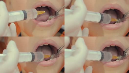 牙医用注射器和吸尘器在孩子嘴里操作高清在线视频素材下载