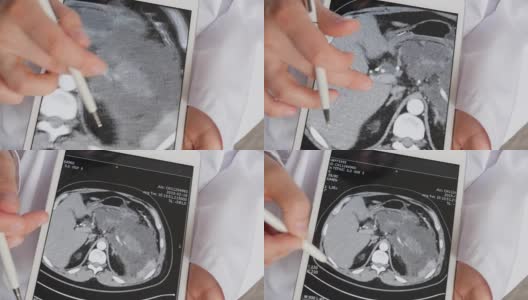 医生正在展示腹腔计算机断层扫描高清在线视频素材下载