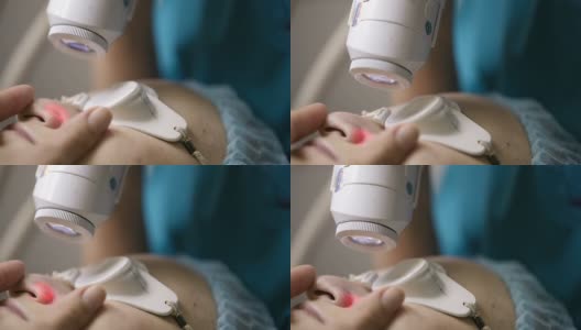 激光皮肤治疗的微距镜头高清在线视频素材下载
