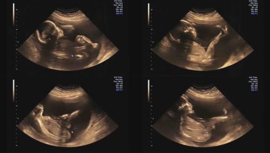 婴儿或胎儿在21周时踢的超声波高清在线视频素材下载