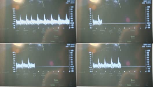 超声扫描仪在医学门诊，特写显示高清在线视频素材下载