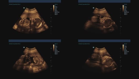 孕妇用超声波检查的记录，显示婴儿在动。在超声波扫描时婴儿会动。怀孕的概念高清在线视频素材下载