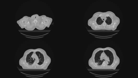 一个肺部肿瘤病人的CT扫描高清在线视频素材下载
