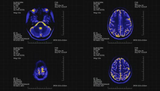 俯视图MRI大脑扫描与数据未来显示动画高清在线视频素材下载