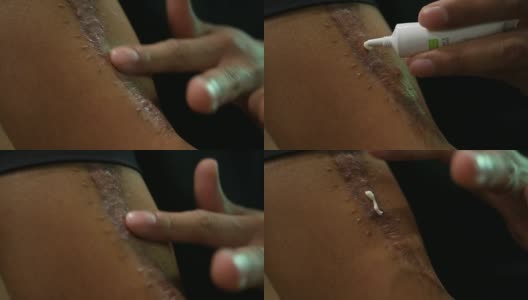 在疤痕上涂药膏高清在线视频素材下载