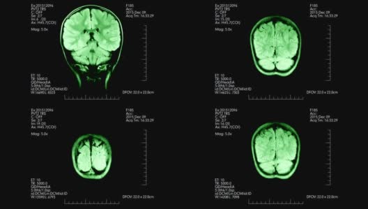 MRI俯视图绿色脑部扫描医学显示附加数据动画高清在线视频素材下载