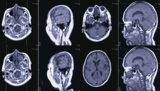磁共振成像(MRI)的大脑轴向和矢状面造影剂高清在线视频素材下载