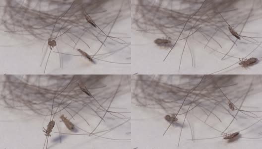 虱子虫对染人的头发团，宏高清在线视频素材下载