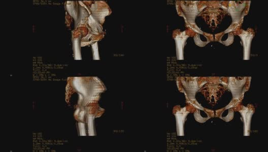 骨盆骨或双髋部CT扫描图像。高清在线视频素材下载