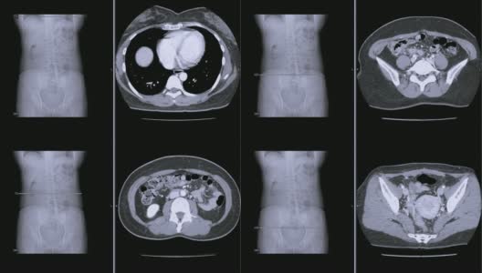 CT扫描/ CT全腹轴位造影剂扫描。阑尾炎的概念。高清在线视频素材下载
