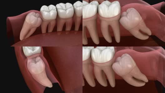 健康牙齿和智齿近中嵌塞。医学上准确的牙齿3D动画高清在线视频素材下载